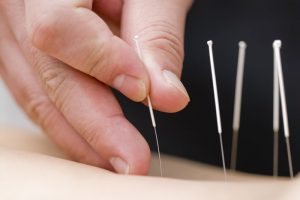 traditional acupuncture